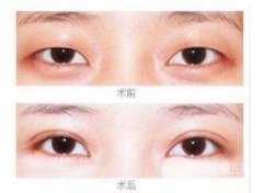 什么是微创双眼皮手术?真的微创么—来看真人果图