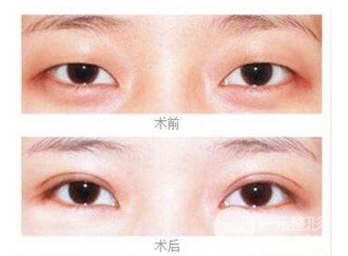 什么是微创双眼皮手术
