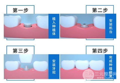 种牙的价格多少