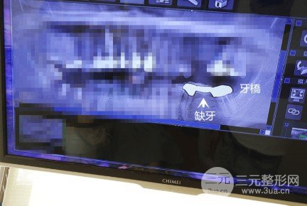 种牙的价格多少