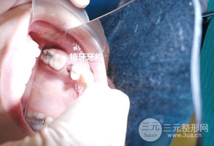种牙的价格多少