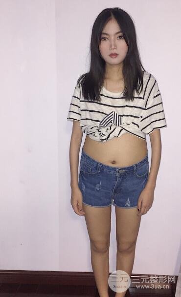 抽脂手术案例