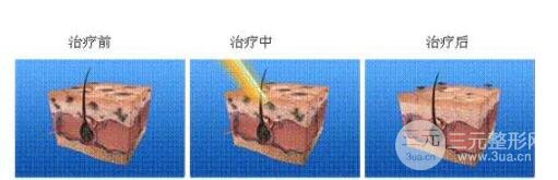 怎样洗掉纹身?