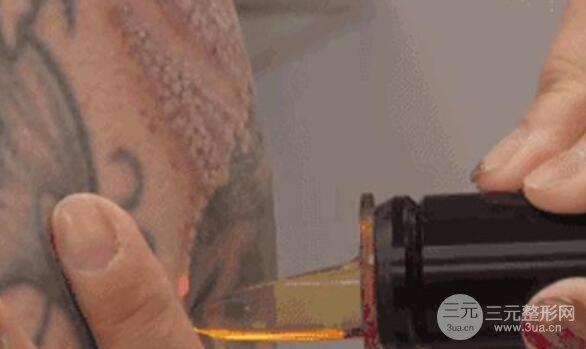 洗掉纹身的费用?