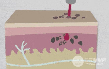 激光去黄褐斑需要做几次