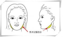 下颌角截骨术果对比图，没想到脸小了好看这么多