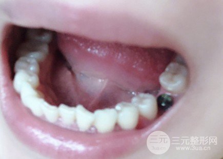 种植牙一颗价格多少