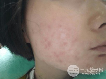 果酸活肤前后对比图