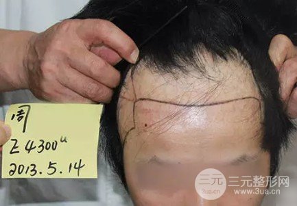 男生发际线中间有个尖发型