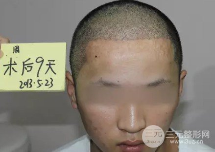 男生发际线中间有个尖发型