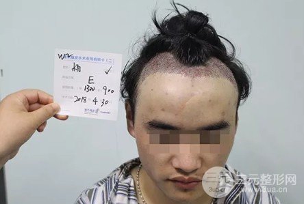 额头太高了怎么改良变低
