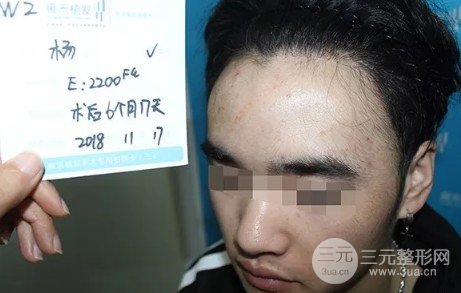 额头太高了怎么改良变低