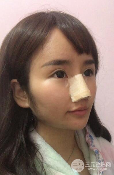 鼻子做完假体9天恢复图高清