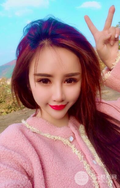 鼻子做完假体9天恢复图高清