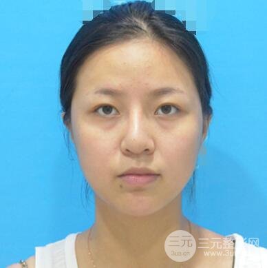 割双眼皮真人案例