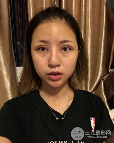 割双眼皮真人案例