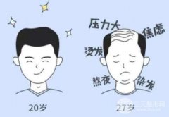 男士植发果图高清发布,基本摆脱秃头方法get 男士植发果图高清发布,基本摆脱秃头方法get
