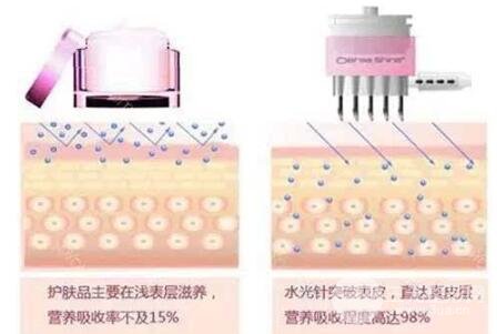 什么是注射补水注射美容?