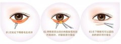 用什么可以去眼袋？3种医美方法帮你去掉它！