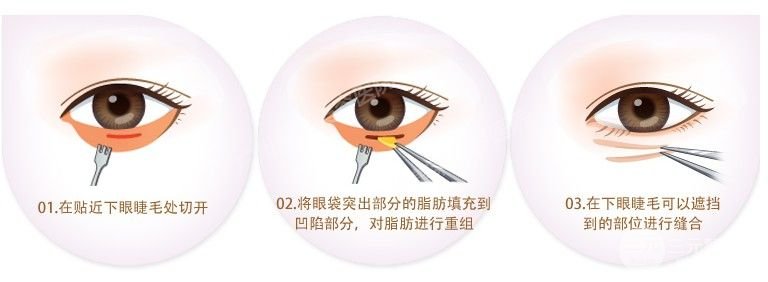 用什么可以去眼袋