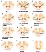缩鼻翼手术风险大吗?2种手术方式可以选择~ 缩鼻翼手术风险大吗?2种手术方式可以选择~