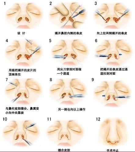 缩鼻翼手术风险大吗