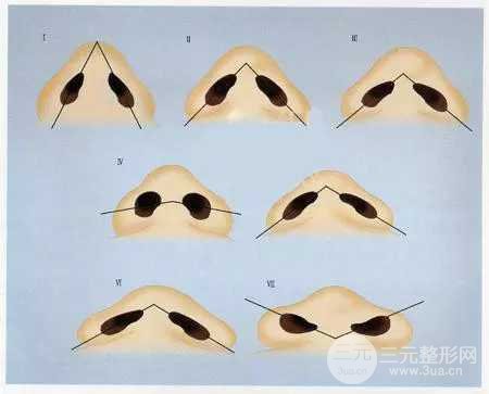 缩鼻翼手术风险大吗