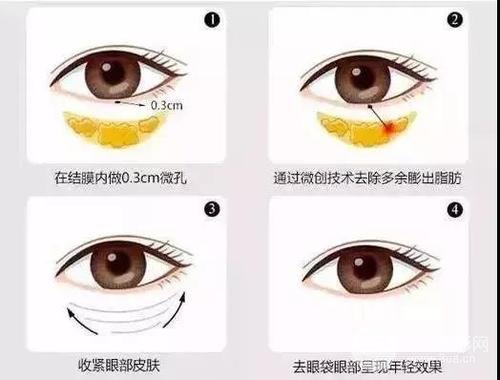 用什么可以去眼袋