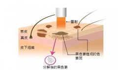 激光祛黄褐斑需要几次缓解？为什么女性爱长斑？
