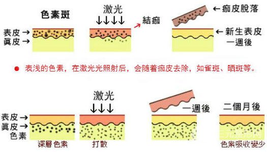 激光祛黄褐斑需要几次缓解