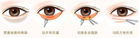 去眼袋手术后遗症