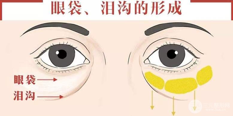 去眼袋手术后遗症