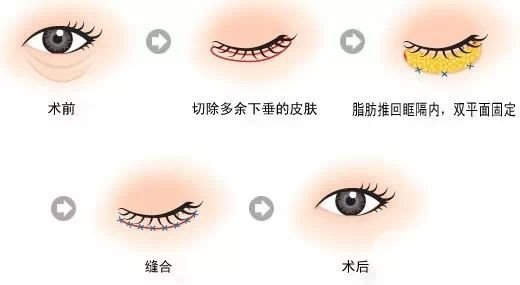 去眼袋手术后遗症