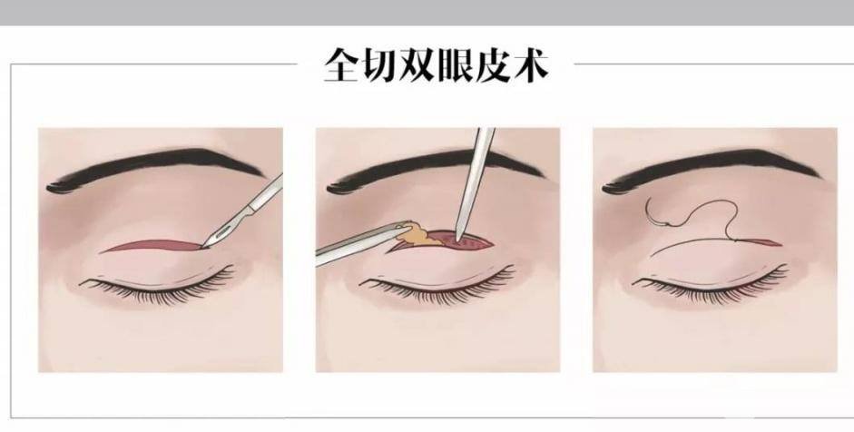 定位双眼皮和全切的区别