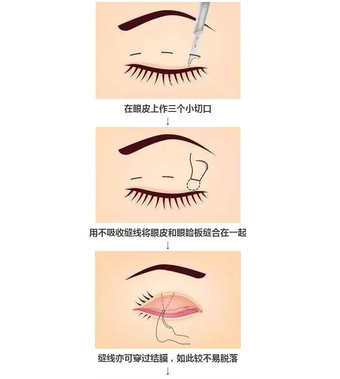 定位双眼皮和全切的区别