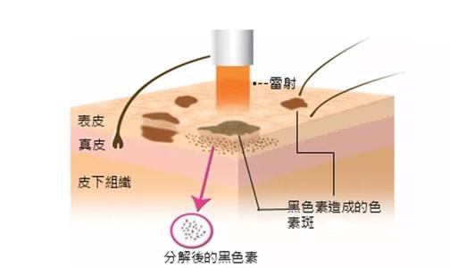 激光祛黄褐斑会反弹吗