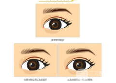 割双眼皮多久恢复？耐心等过5个阶段才有美丽自然的大眼睛！