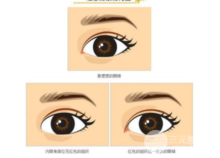 割双眼皮多久恢复