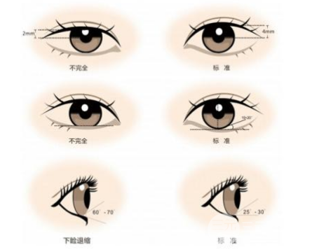 割双眼皮多久恢复