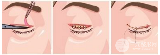 割双眼皮多久恢复