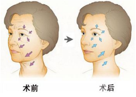 什么叫ZJ小切口除皱