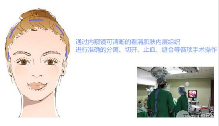 什么叫ZJ小切口除皱