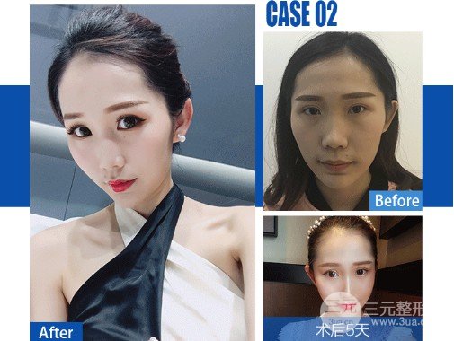 镭射美白有副作用吗