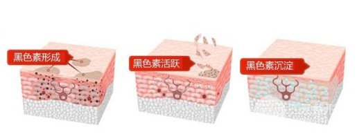 镭射美白有副作用吗