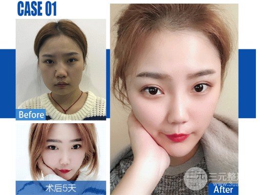 镭射美白有副作用吗