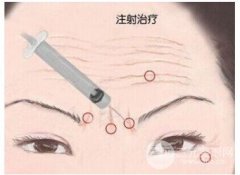 注射除皱降低风险吗?打几次能看到果啊? 注射除皱降低风险吗?打几次能看到果啊?
