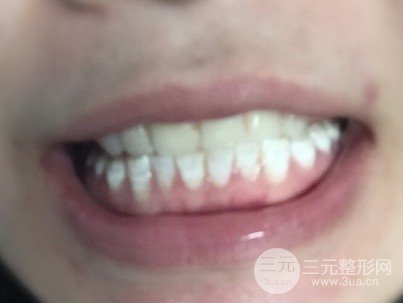 烤瓷牙一般费用多少