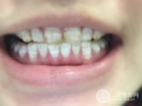 烤瓷牙一般费用多少