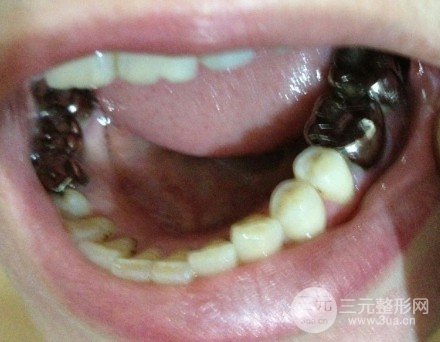 烤瓷牙一般费用多少