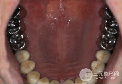 烤瓷牙一般费用多少